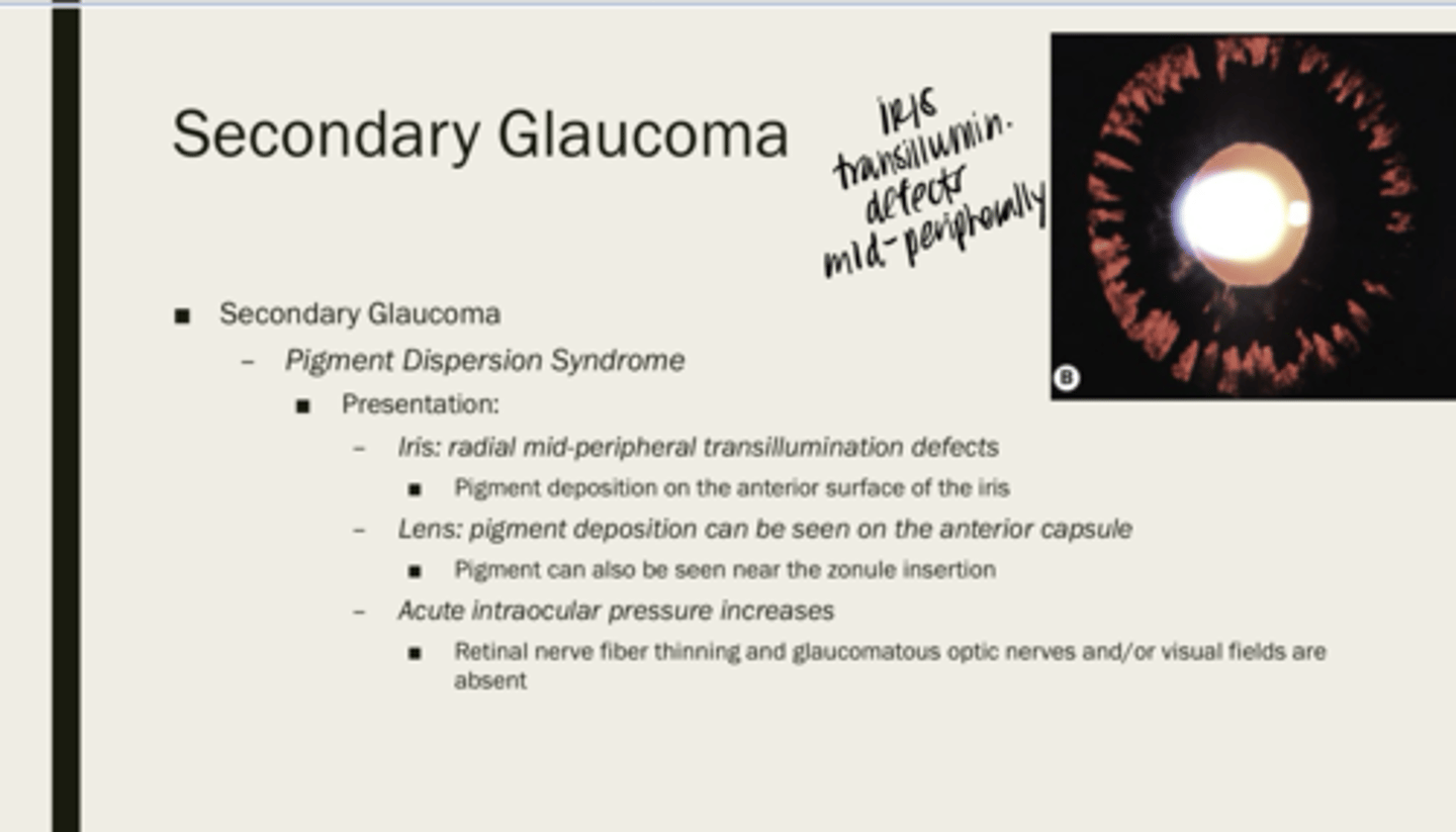 <p>What is the presentation of pigment dispersion syndrome on the iris?</p>
