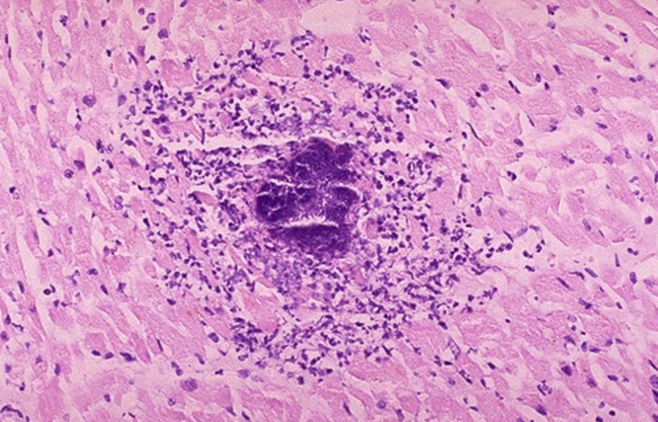 <ol><li><p>PMNs</p></li><li><p>bacterial debris</p></li></ol><p></p>