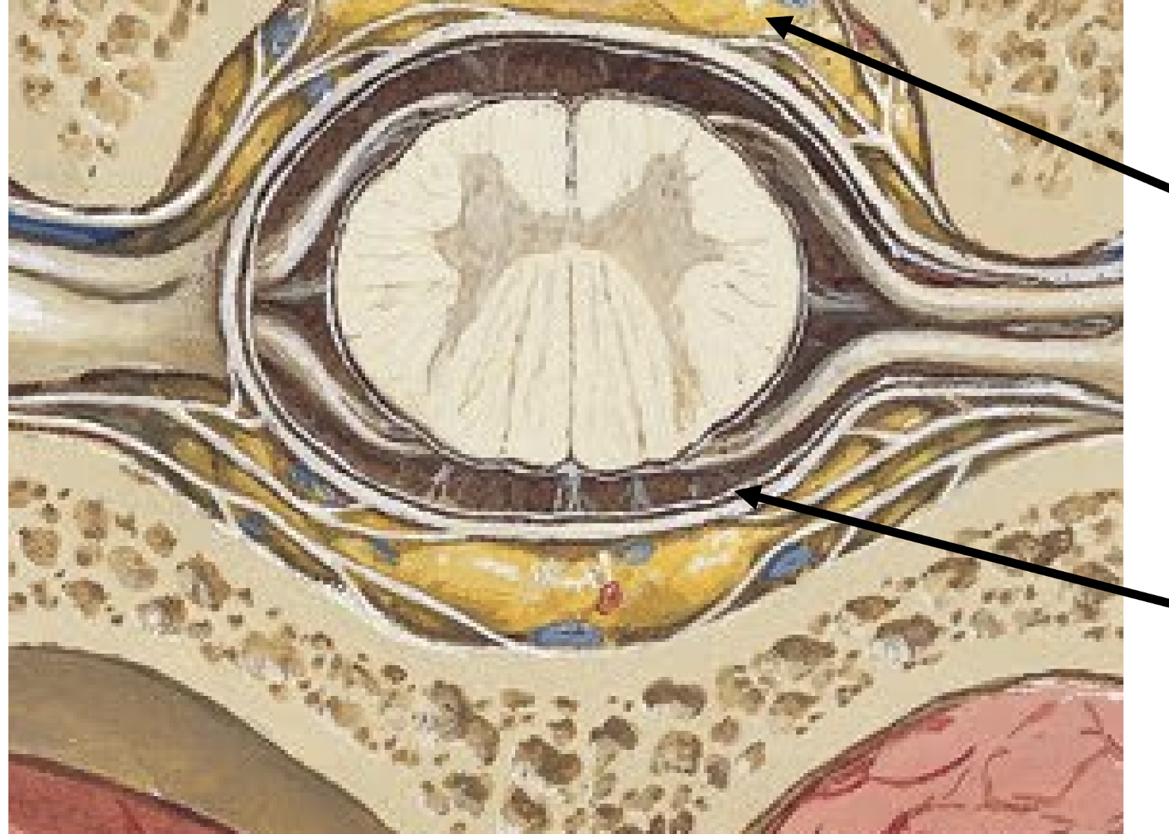 <ul><li><p>deep to dura, between dura and arachnoid</p></li><li><p>nothing found here normally</p></li></ul><p></p>