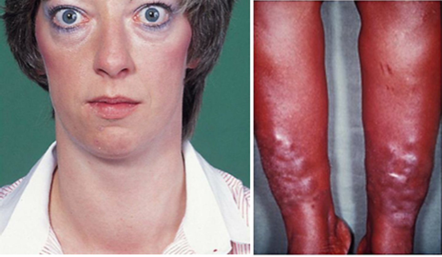 <p>Excess secretion of thyroid hormone (hyperthyroidism).</p><p>Classic signs include difficulty eating, mild facial edema, and abnormal protrusion of eyes.</p><p>Other symptoms include heat intolerance, weight loss, nervousness, muscle weakness/fatigue, tremor and palpations.</p><p>Increased DTRs</p>
