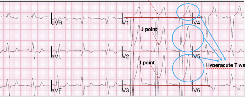 <p>represented by ST segment elevation</p>