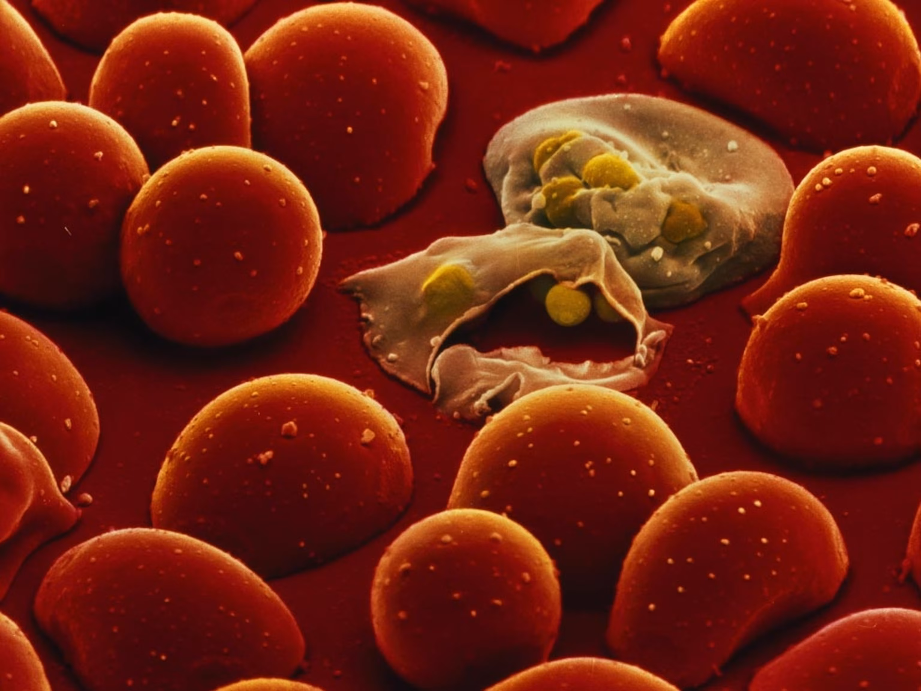<p>caused by : Plasmodium Parasites ( protozoan ) </p><p>Vector : anoheles mosquito </p><ul><li><p>caused by multiple species </p></li><li><p>So Many Godamn Zites Stop !</p></li></ul><p></p><p></p>