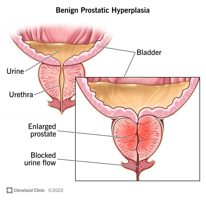 <ul><li><p>Age-associated (50+) prostate gland enlargement that can cause urination difficulty (not a precursor to prostate cancer)</p></li><li><p>symptoms include frequent urination, trouble starting to pee, urination at night</p></li></ul>