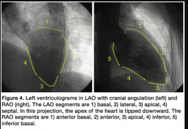 <ol><li><p>anterior basal</p></li><li><p>anterior</p></li><li><p>apical</p></li><li><p>inferior</p></li><li><p>inferior basal </p></li></ol><p></p>