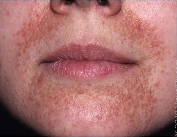 <p>what condition?</p><ul><li><p>discrete erythematous micropapules and microvesicles around mouth/nose/eyes</p></li><li><p>no comedones</p></li><li><p>assoc w/ atopy</p></li><li><p><strong>spares narrow area around vermillion border</strong></p></li><li><p>risk: F, age 16-45, TCS use</p></li></ul><p></p>