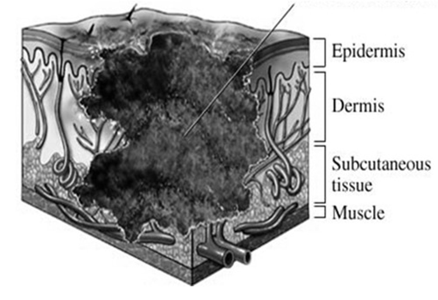 <p>Loss of epidermis, dermis, and subcutaneous tissue and/or deeper</p><p>Requires granulation/contraction</p><p>Higher infection risk</p><p>Often needs advanced closure/grafting</p>