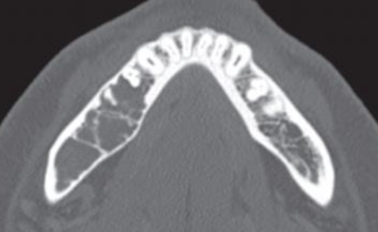 <p>Odontogenic Myxoma</p>