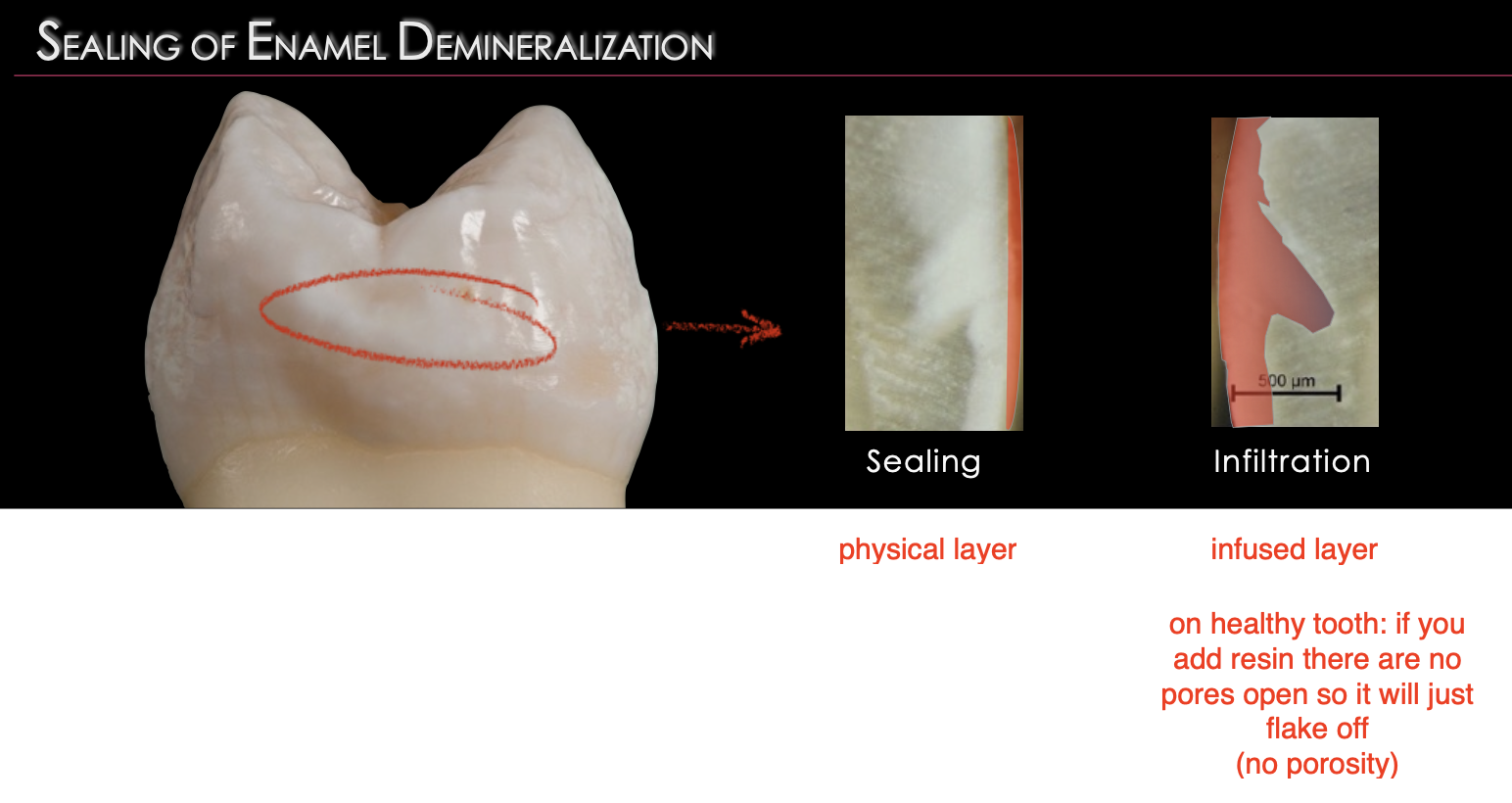 <ul><li><p>resin infiltration prevents acid demineralizing tooth gets absorbed</p></li><li><p>sealant is different bec just cover tooths</p></li></ul><p></p>