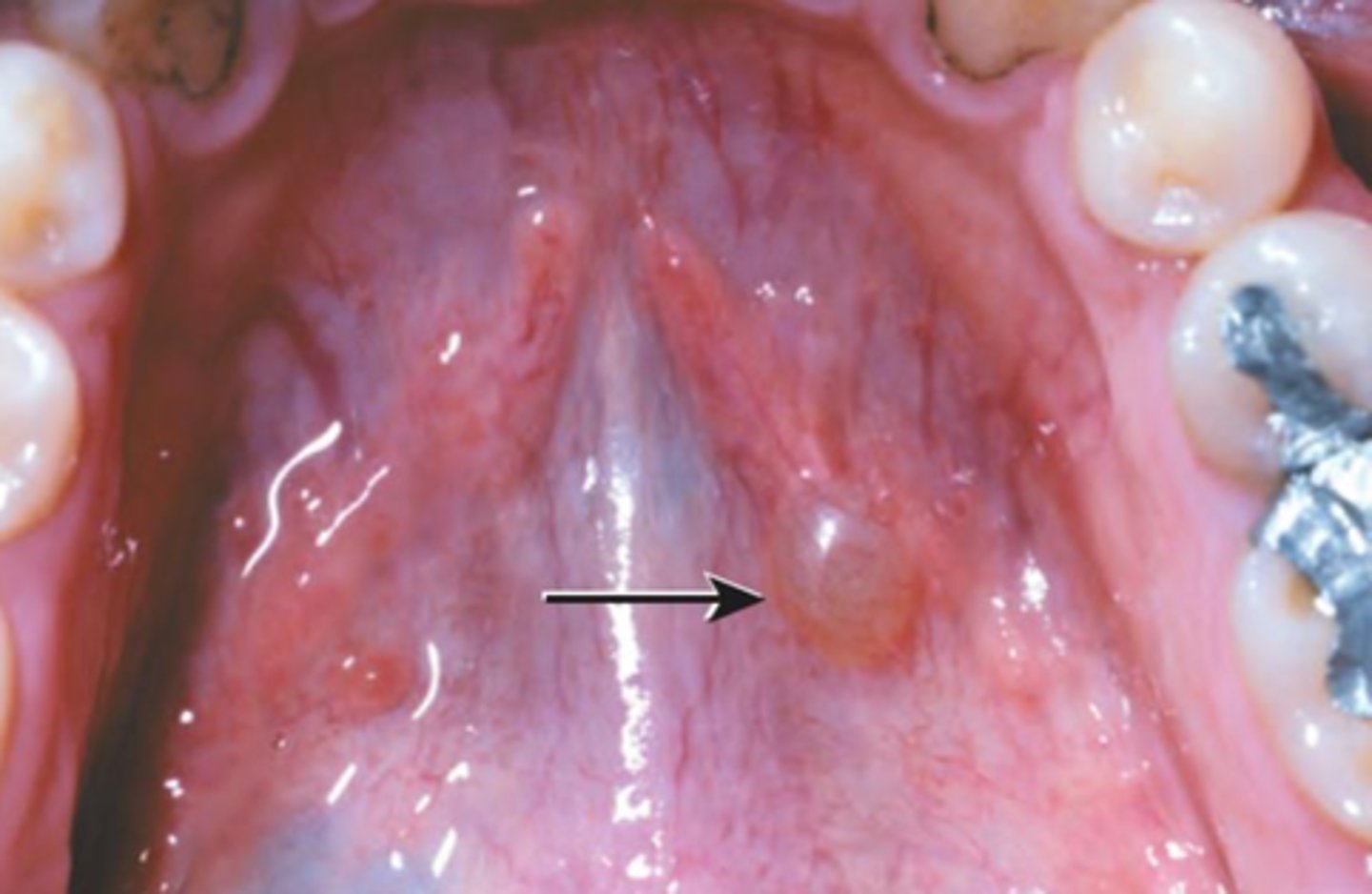 <p>Mimic mucoceles in</p><p>appearance</p>