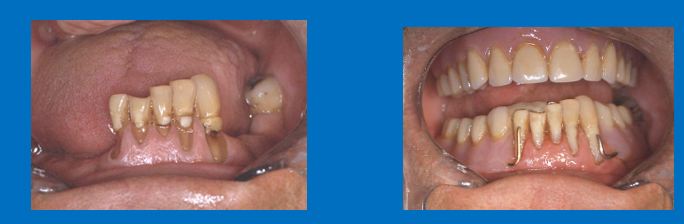 <p>In an edentulous arch opposing a partially dentate arch</p><p>what horizontal relationship/occlusion will be used?</p><p>What is the problem with the vertical/OVD determination for this patient?</p>