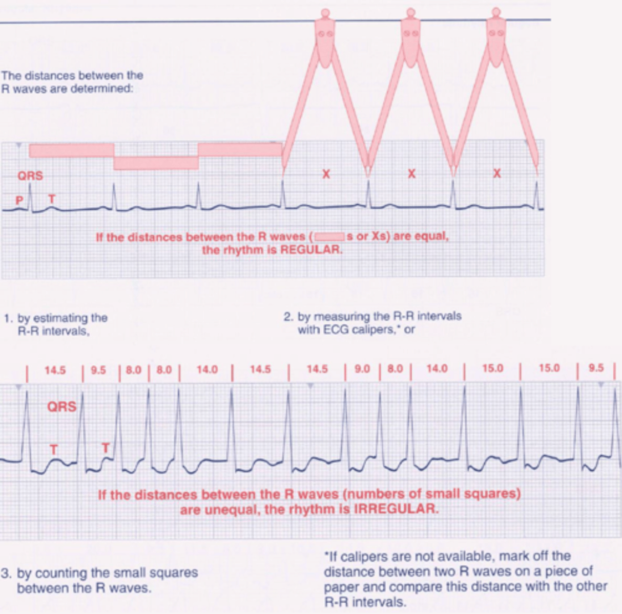 <p>- Is the rhythm regular of irregular?</p><p>- Are there any patterns to the regularity?</p><p>- Are there any ectopic beats, if so are they early or late?</p>