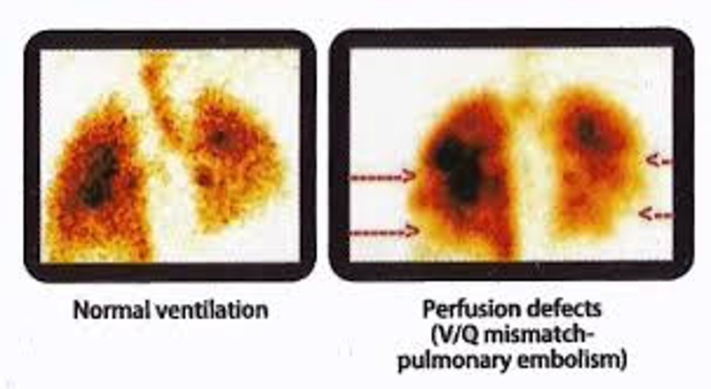 <p>Used to evaluate PE, R to L shunt, lung function before surgery</p><p>-Uses argon gas --&gt; ventilation</p><p>-Tags RBCs --&gt; perfusion</p>