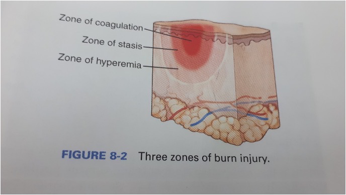 <ol><li><p>zone of coagulation </p></li><li><p>zone of statsis</p></li><li><p>zone of hyperaemia </p></li></ol>