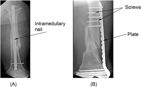 <p>The above pictures are X-rays of a family member. This X-ray of her fracture illustrates: </p>