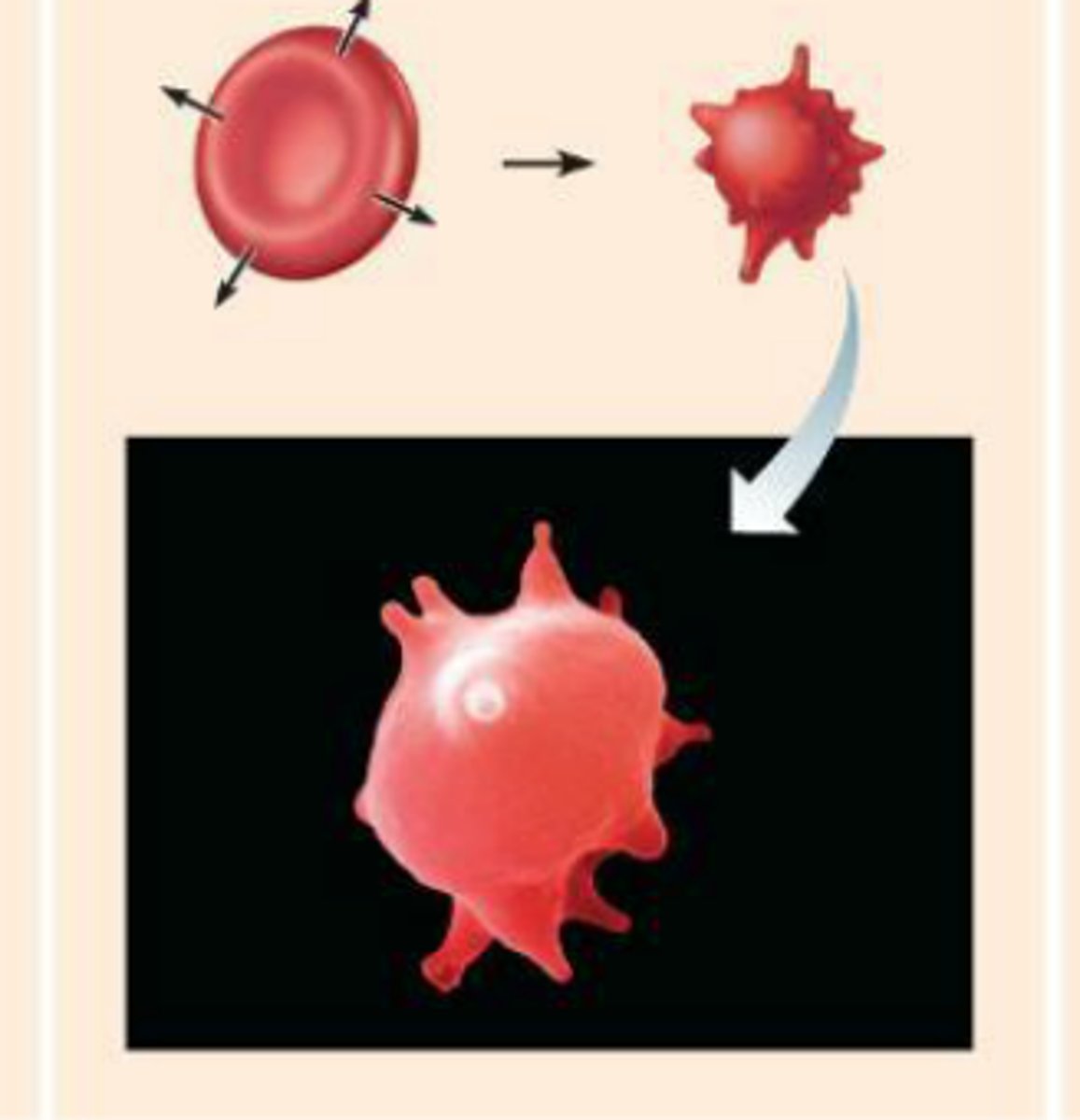 <p>-loses water to its surroundings</p><p>-concentration of solutes is higher outside of cell</p><p>-water moves to extracellular fluid</p><p>-cells shrivel and die</p>