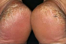 <p><span>A thin linear crack in the skin which is deeper than it is wide.</span></p>