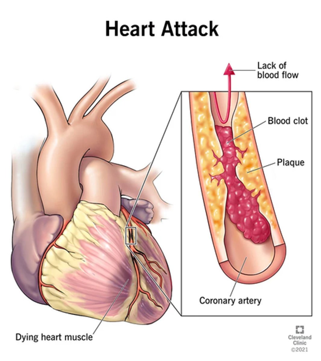 <p>-death of the myocardium from the sudden blockage of coronary blood flow</p><p>-aka a heart attack</p><p>-myocardial oxygen supply cannot meet body's oxygen's supply</p><p>-myocardial cells die</p>