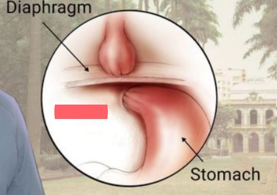 <p>stomach bulges through the diaphragm</p>