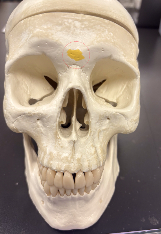 <p>crack in the middle of the forehead</p>