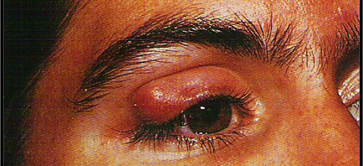 <p>acute infection of meibomian gland deep to the eyelid surface</p>