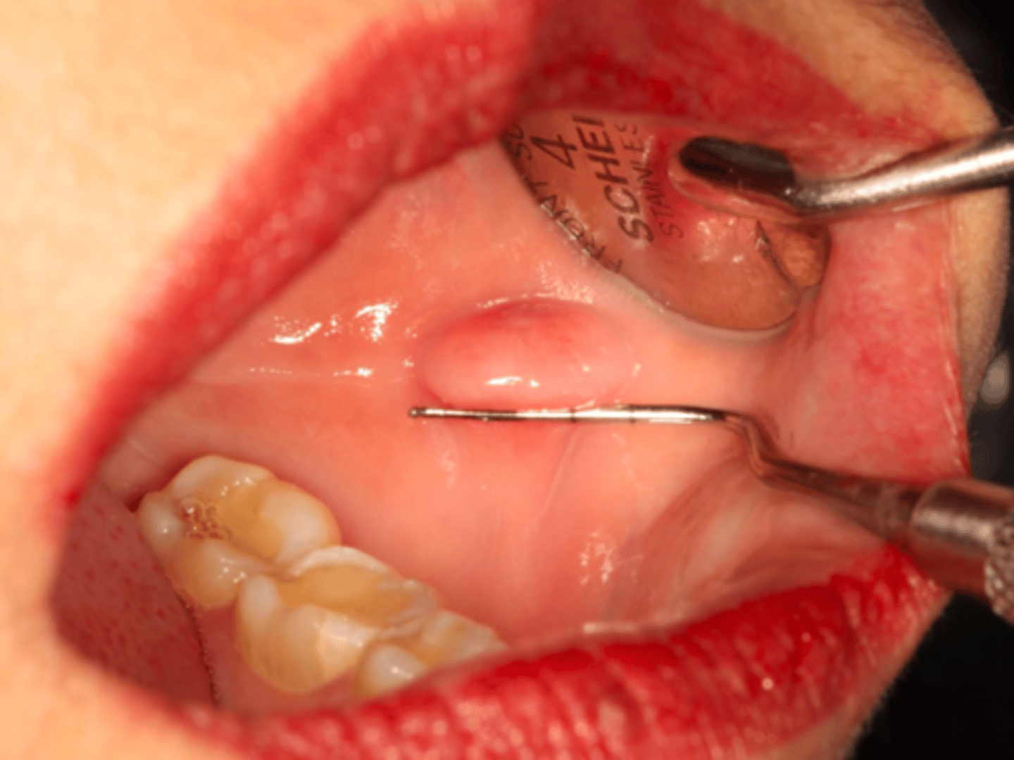 <p>patient presents with a pink nodule on the buccal mucosa. Patient claims they have always bitten their cheek and started to notice a "bump" forming near the same area. What could this be?</p>