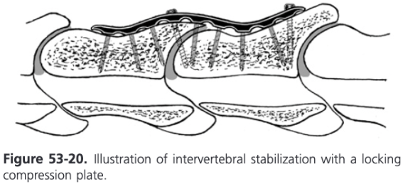 <ul><li><p><span>Complete removal of disc material has been suggested to be essential for good fusion</span></p></li><li><p><span>A bone graft can be inserted into the ventral intervertebral space as well</span></p></li><li><p><span>Standard 4.5/5.0 mm narrow or broad 8-hole LCP is used with 5.0 mm self-tapping locking head screws</span></p></li><li><p><span>Self-drilling and self-tapping screws should not be used because a considerable amount of threaded screw length is lost because of the drilling device at the tip of the screw</span></p></li><li><p><span>Important to use the longest screws possible and to place the central cortex screw across the intervertebral articulation as a position or lag screw</span></p></li><li><p><span>The application of the plate to the ventral aspect of the bone violates the principle of applying the plate to the tension side of a bone</span></p><ul><li><p><span>As a result, flexion of the neck predisposes the fixation to failure by causing screw retraction from the bone</span></p></li></ul></li></ul><ul><li><p><span>New bone formation can usually be seen radiographically on the ventral aspect by 2 months postoperatively and progresses to a stable callus by 10 months</span></p></li></ul>