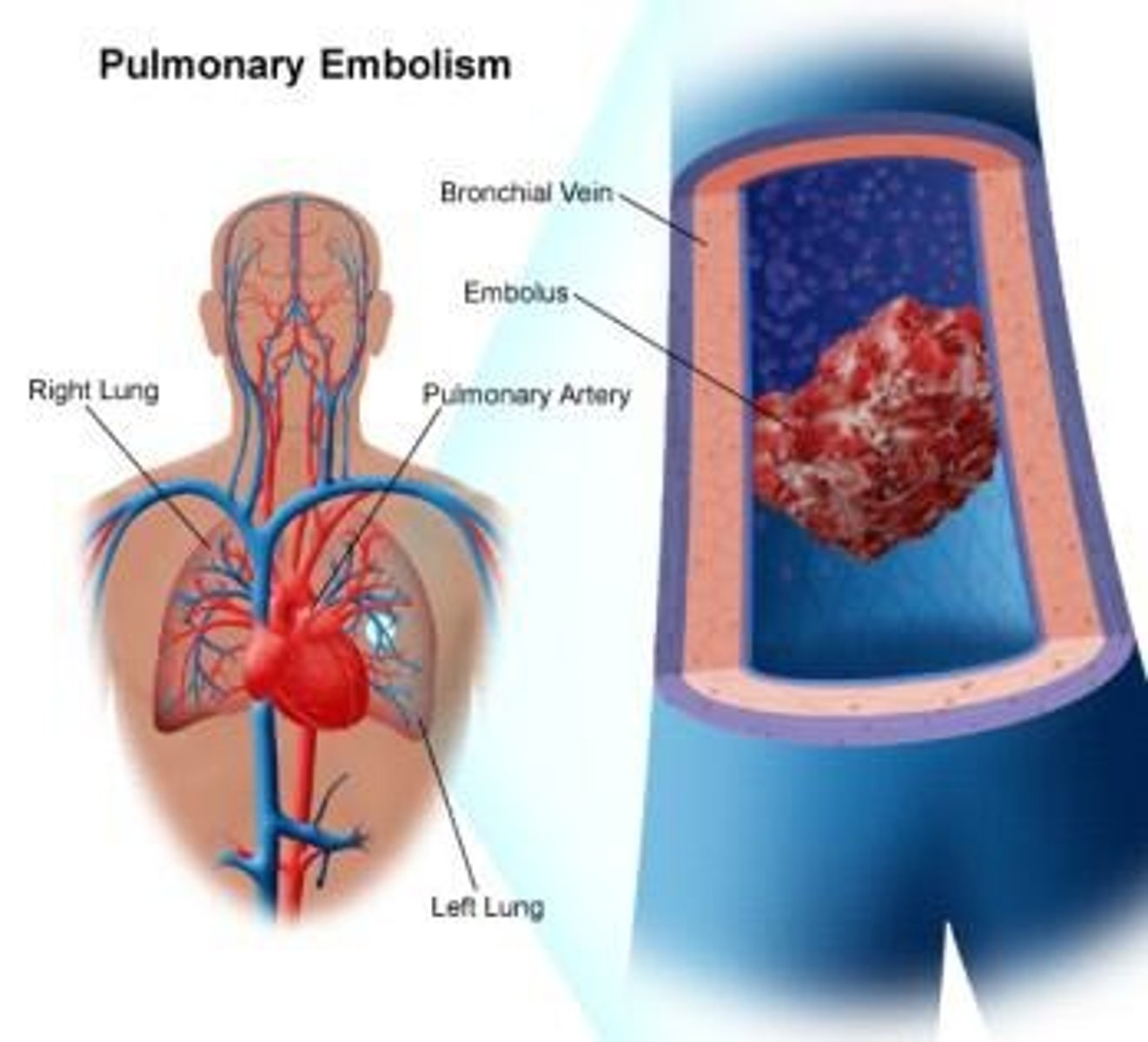 <p>Pulmonary embolism, deep vein thrombosis (DVT), skin breakdown, incontinence, infections, orthostatic hypotension, and contractures.</p>