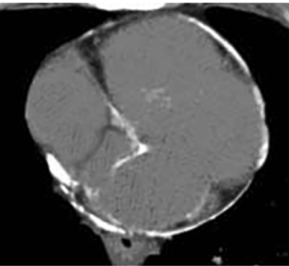 <p>increased JVP w/ inspiration</p><ul><li><p>seen in <strong>constrictive pericarditis</strong> along w/ pericardial knock, PParadoxus (&gt;10mmhg drop in systolic w/ insp), calcification</p></li></ul><p></p>