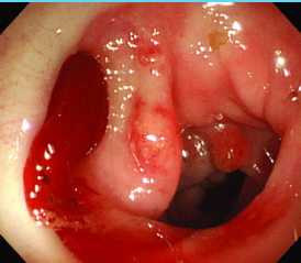 <p><strong>Diverticular Bleeding: Background</strong></p><p>-Most common cause of overt _____ GI bleeding, where most bleeding stops _____________</p><p>-Risk Factors → age > __, bilateral diverticulosis, and obesity </p><p>-Symptoms → __________ hematochezia or dark/maroon colored ____</p><p>-Diagnosis/Treatment</p><ul><li><p>___________ (test of choice) → provide endoscopic therapy (submucosal epinephrine injection or tamponade)</p></li><li><p>Nuclear scintigraphy with angiography → angiographic therapy (infusion of vasoconstricting meds or embolization)</p></li><li><p>Surgical intervention → segmental or subtotal colectomy </p></li></ul><p></p>