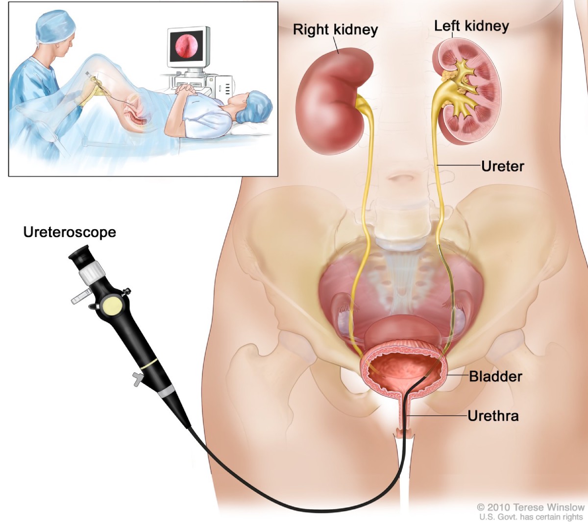 <p>Done to examine pelcialyseal system and ureters by using catheters to administer contrast directly into the area against normal flow</p>