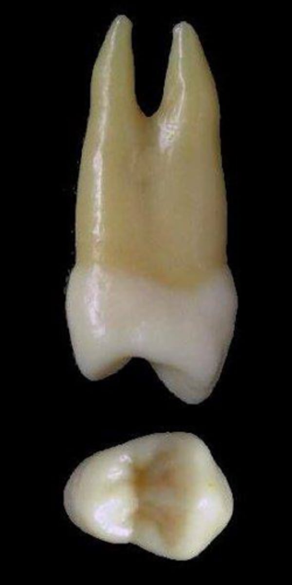 <p>what tooth is this &amp; why?</p>