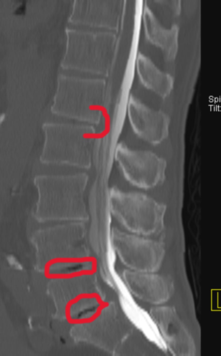 <p>Name the pathology circled in red</p>