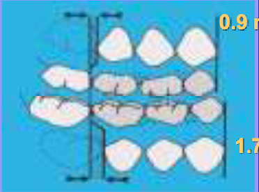 <p><span><span>difference in size between the larger primary canines and molars and their smaller permanent successors</span></span></p>