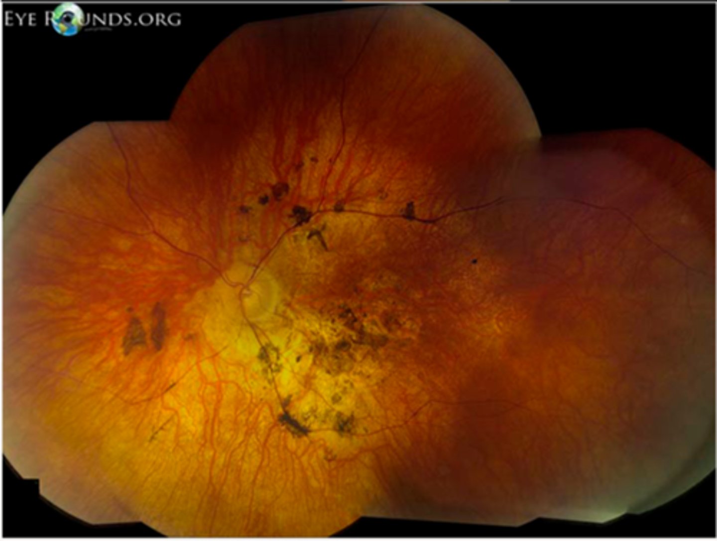 <p>AR genetic condition causing ciliopathy throughout the body with juvenile onset</p>