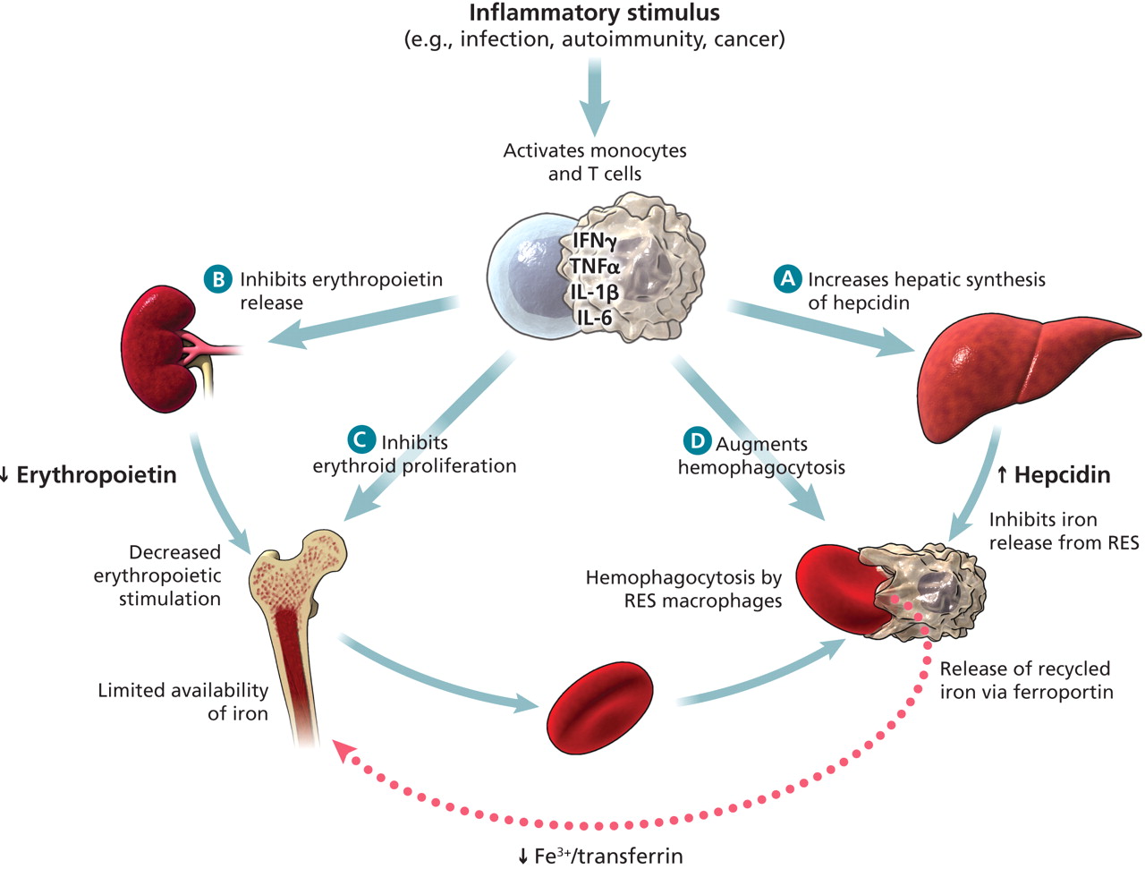 <p>Inflammatory stimulus activates monocytes and T- Cells releasing a flood of cytokines which:</p><p>1) Inhibits EPO release</p><p>2) Decreased EPO inhibits erythroid proliferation</p><p>3) Augments hemophagocytosis</p><p>4) Increases hepatic synthesis of hepcidin which inhibits iron release form RES. Also inhibits release of recycled iron via ferroportin.</p>