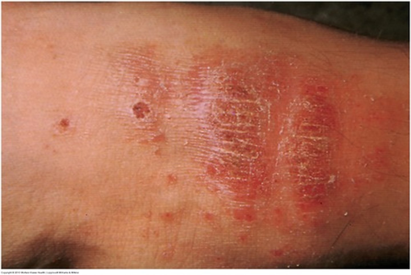 <p><b>Secondary</b> <br><br>Visible and palpable thickening of the epidermis and roughening of the skin with increased visibility of the normal skin furrows <br><br>example: neurodermatitis</p>