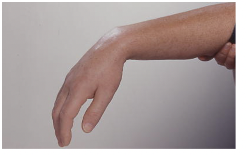 <p>Nerve implicated?</p><p>MO injury?</p>
