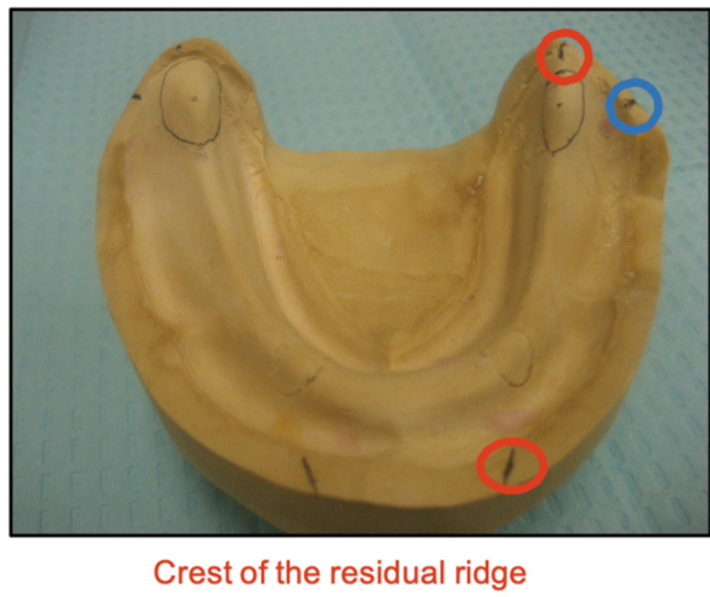 <p>It is important that we mark the crest of the mandibular ridge correctly because, if we set teeth too buccally, what would happen?</p>