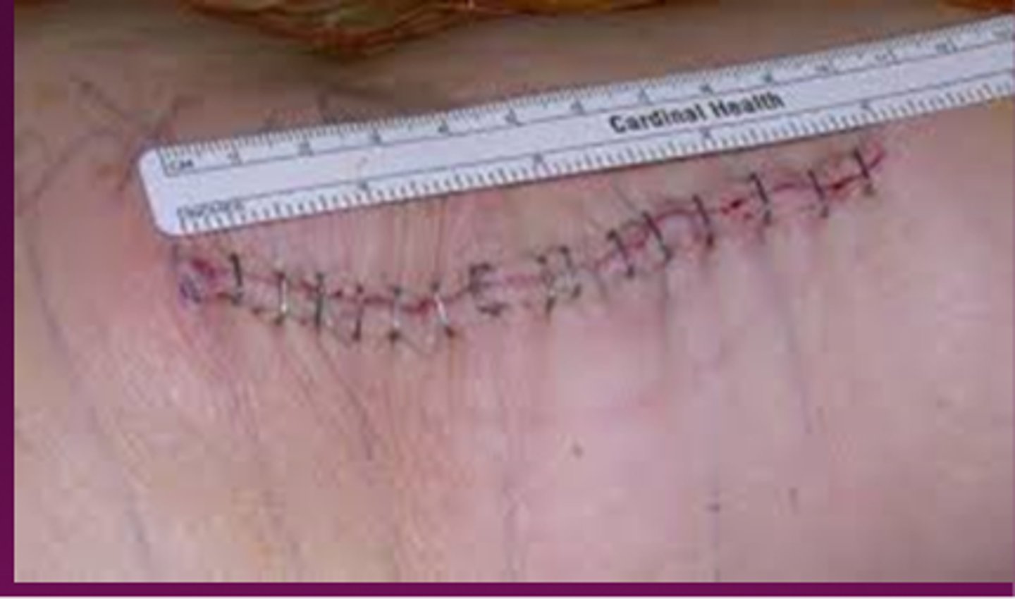 <p>wound that is closed with edges clean and intact ex: trauma or surgical incision</p>