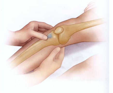 <p>sääriluun kyhmy</p>