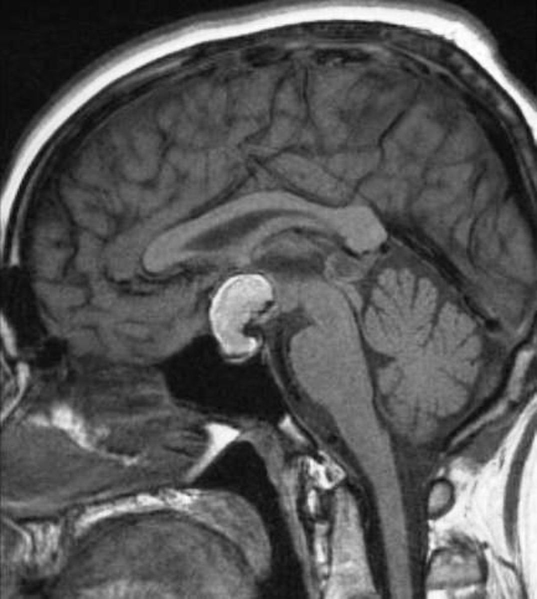 <p>Benign tumor causing excess GH secretion.</p>