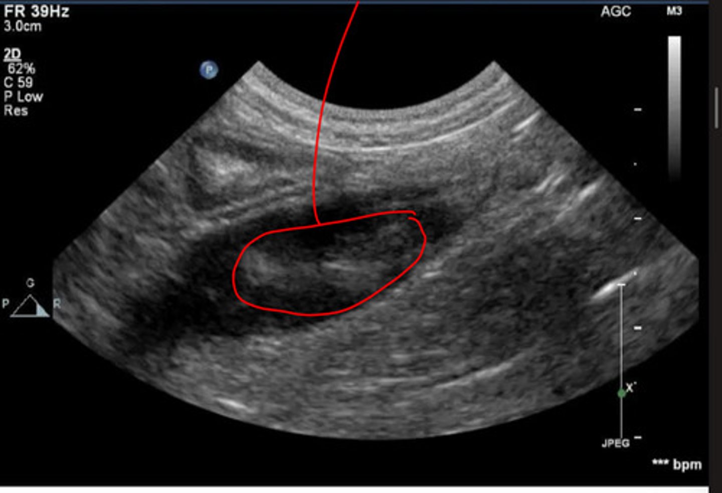 <p>what abnormality in this vessel?</p>