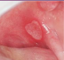 <p>What is the management for aphthous ulcer (stomatitis)?</p>