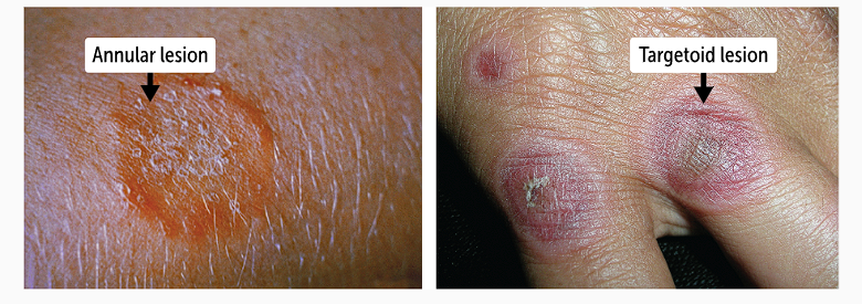 <p>can differential tinea corporis annular lesions from the targetoid lesions in patients with erythema multiforme</p><p></p><p>also patients with SLE tend to have <strong>discoid lesions, including at fingers</strong></p>