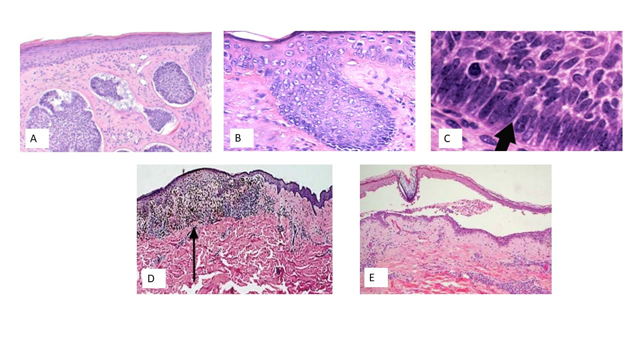 <p><span>Which of the following H&amp;E images shows Malignant Melanoma?</span></p><p><span>Image A</span></p><p><span>Image B</span></p><p><span>Image C</span></p><p><span>Image D</span></p><p><span>Image E</span></p>