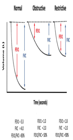 <ul><li><p>obstructive: both FCV and FEV1 decrease, but FEV1 decreases much more so percentage goes down substantially</p></li><li><p>restrictive: both FCV and FEV1 decrease, but similar amount so percentage stays relatively the same or even can increase.</p></li></ul><p></p>