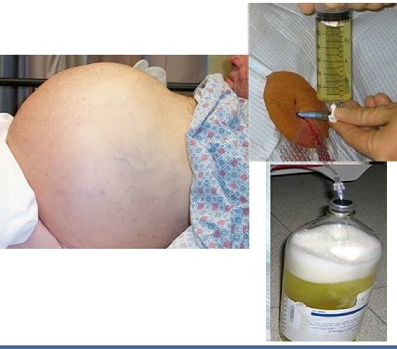 <p>→ Albumin and furosemide</p><p><strong>Paracentesis </strong>(insertion of the catheter in the abdomen/liver to remove the fluid)</p><p>Patient needs to be NPO for 4 to 6 hours</p><p>Assess output</p><p>Monitor VS</p><p><strong>Pre-procedure</strong>—assess coagulation studies, void prior to procedure. </p><p>- PPT and INR because liver makes coagulants</p><p>- If this is compromised, pt will require platelet or plasma replacement before the surgery is done</p><p>- Need to void prior to procedure so there is a decrease risk in puncturing the kidney</p><p>Educate the patient on what to expect</p><p>2x2 in the stomach, stay in bed for 2 hr</p>