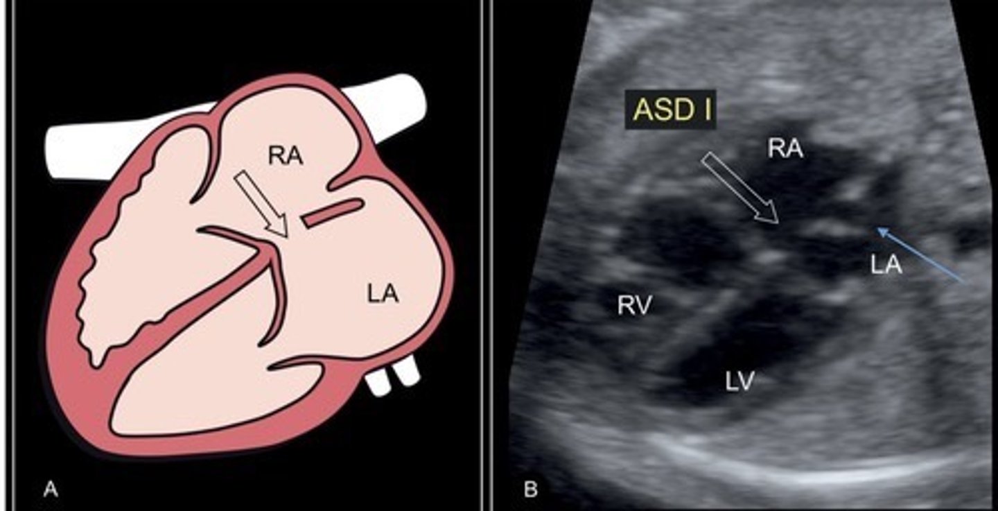<p>Best seen when IAS is perpendicular to sound beam</p><p>Hole in atrial septum</p>