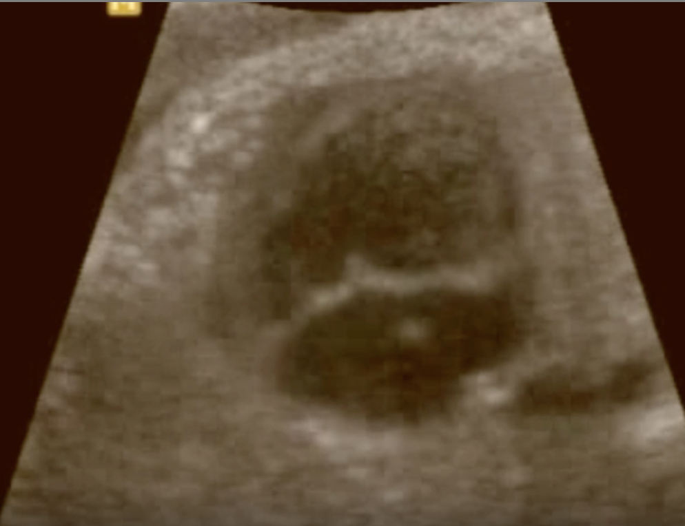 <p>a) turner syndrome</p><p>b) trisomy 13</p><p>c) trisomy 18</p><p>d) trisomy 21</p>