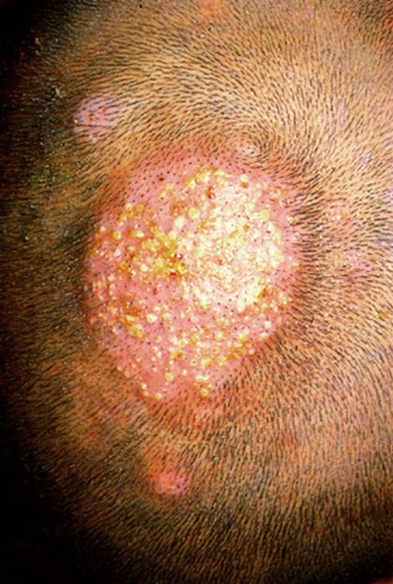 <p>Tinea Capitis</p>